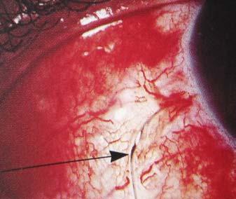 16 Corneal laceration with iris prolapse - Soft eye.