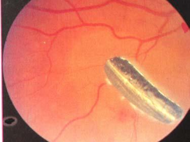 - Watch out for lid stabs that may hide a stab injury to the eye itself Fig.