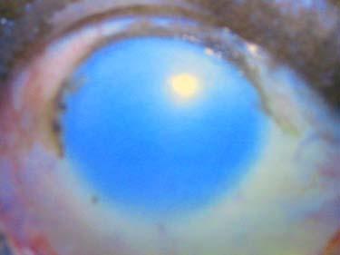 Chemical Burns - Do not waste time with a detailed history and examination, especially if due to alkali - Alkali burns can cause long term corneal and conjunctival scarring, including untreatable