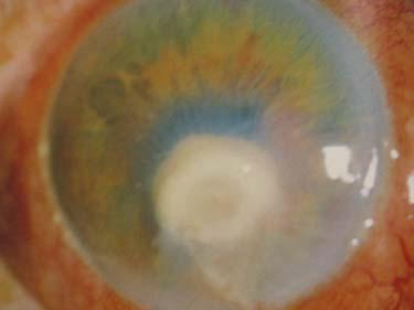 Bacterial Corneal Ulcer/ Abscess - Red and painful eye - mucopurulent
