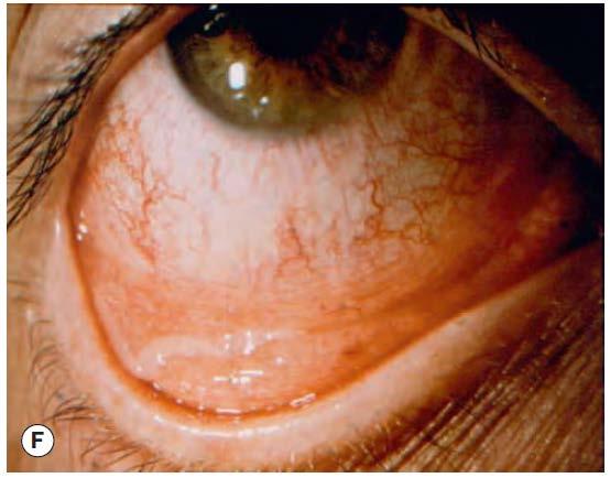 Allergic conjunctivitis Itchy Stringy discharge?