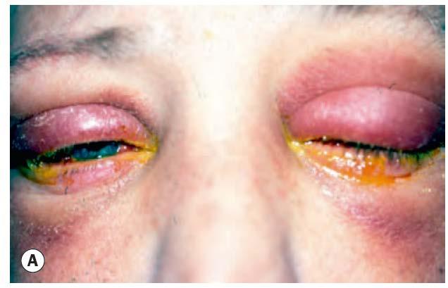 Bacterial conjunctivitis Usually bilateral Sticky,
