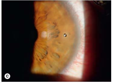 Corneal foreign body / abrasion Pain, foreign body