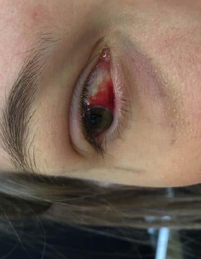 Subconjunctival haemorrhage Diffuse area of blood