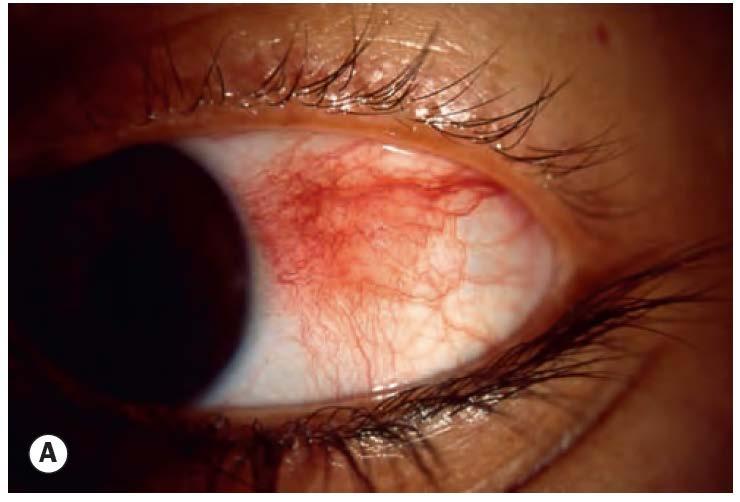 Episcleritis Usually unilateral Irritation, photophobia Decreased vision?