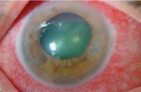 Very HIGH intraocular pressure Treatment Refer urgently Acetazolamide