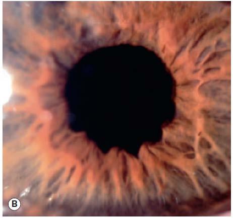 exam with dilated fundus