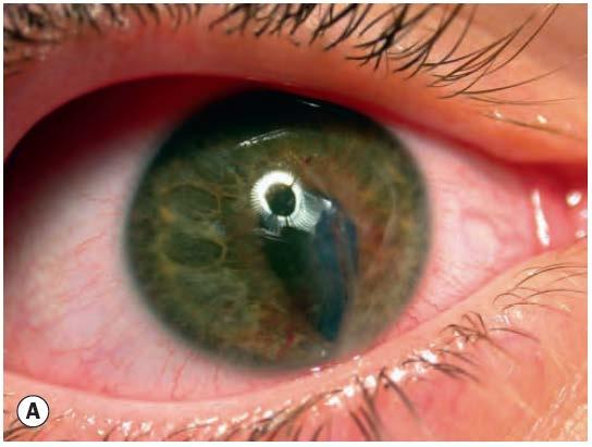 Penetrating eye injuries Do not check pressure Decreased