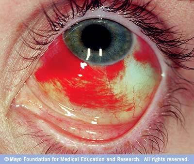 Subconjunctival Hemorrhage Causes : sudden increase in ocular venous pressure - spontaneous - Valsalva maneuver - trauma -