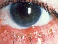 Treatment of blepharitis Warm compresses Eyelid hygiene Antibiotics