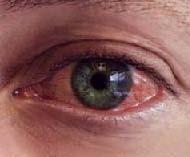Conjunctivitis Infectious (viral, bacterial, chlamydial) or non infectious (allergies, irritants ) Cause can be distinguished by the history and physical examination.