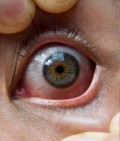 Episcleritis Inflammation of the superficial vessels Recurrent and unilateral, but it can