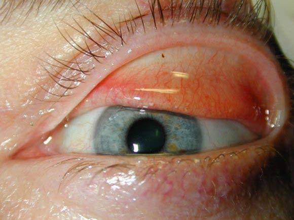Ocular foreign body Irritation, redness, and pain. Suspect if appropriate history.