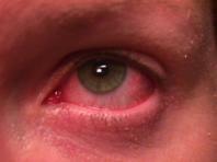 39 WF 6 week hx of bilateral red eyes R>>L with