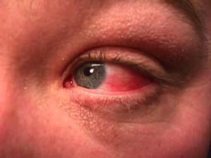 Slide 68 Initial Red Eye or Irritation Causes Mucous Production