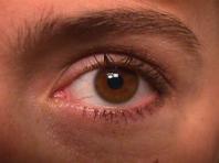 secondary (dendritic) Dendrites can affect cornea