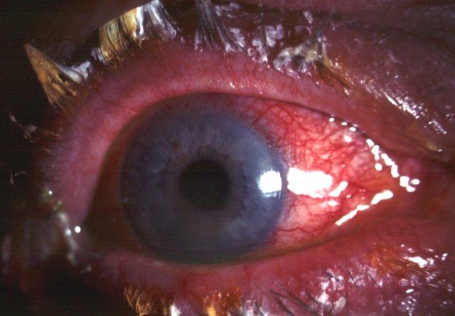 Simple bacterial conjunctivitis Signs Crusted eyelids and conjunctival injection