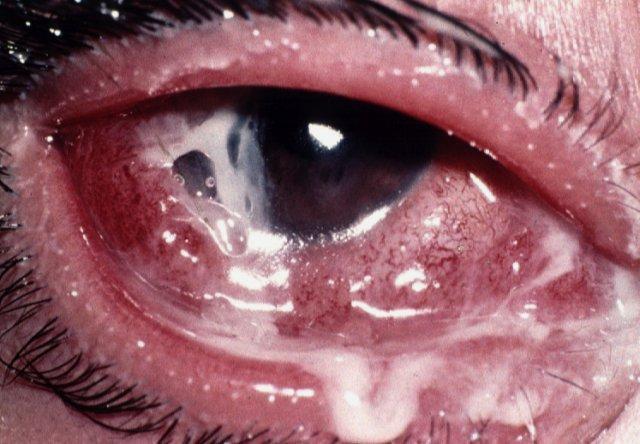 Gonococcal keratoconjunctivitis Signs Complications Acute,