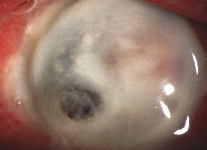 ulceration, perforation and endophthalmitis if severe Treatment