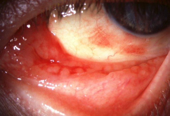 Adult chlamydial keratoconjunctivitis Infection with Chlamydia