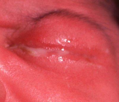 Neonatal chlamydial conjunctivitis Presents between 5 and 19 days after birth May be associated with otitis,