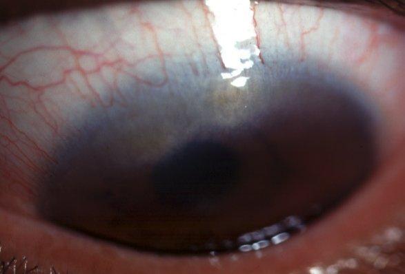 Trachoma Infection with