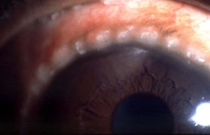 DIAGNOSTIC STEP 2 Type of redness Diffuse Subconjunctival