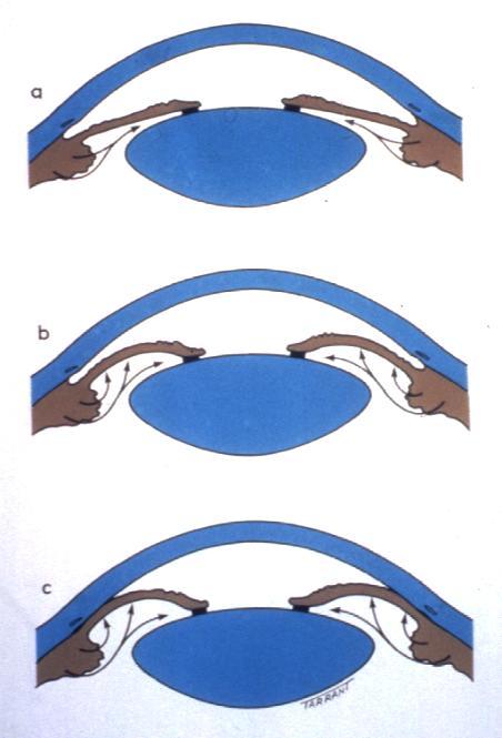 Pupil block Increase in physiological pupil block Dilatation of pupil renders peripheral iris more flaccid