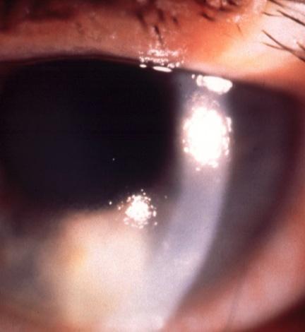 Intermittent angle-closure glaucoma