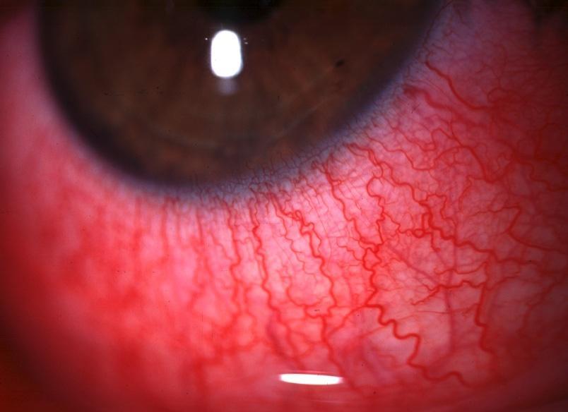 systemic disorder Simple sectorial Simple diffuse episcleritis