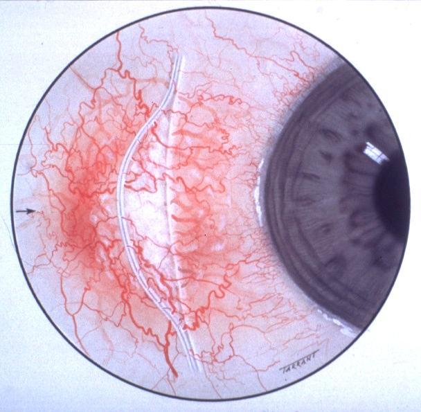 similar to simple episcleritis Localized nodule which