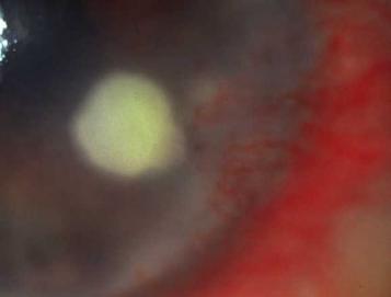 DIAGNOSTIC STEP 4 Detect cornea opacities Irregular surface Leucoma Ulcer Keratic