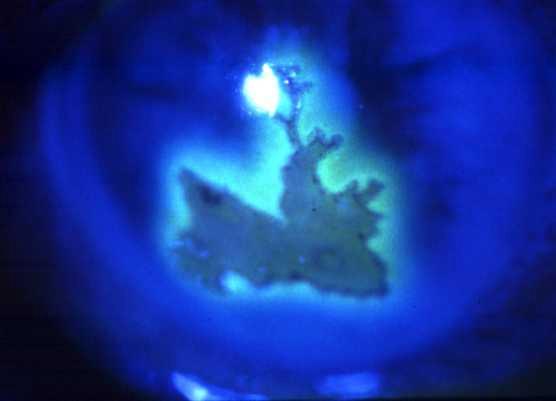 bulbs Stains with fluorescein May enlarge to become geographic Treatment