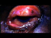 Trachoma with extensive
