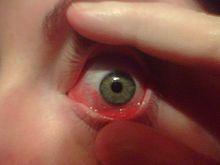 Viral conjunctivitis: Conjunctiva (Cont d) Adenovirus (the most common cause) HSV (the most problematic) Less common causes include:vzv, enterovirus 70,