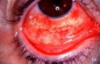 Conjunctiva (Cont d) Epidemic Keratoconjunctivitis (EKC): A type of adenovirus ocular infection Sudden onset of acute follicular