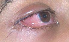 Conjunctiva (Cont d) Allergic conjunctivitis Itching