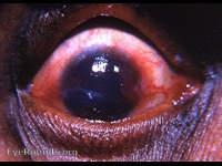 Trachoma with
