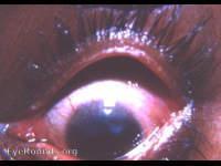 Trachoma: a perfect photo of established trachoma with