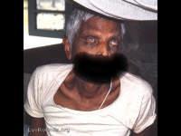 Leprosy: patient is blind due