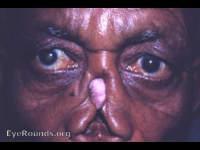 Syphilis and Trachoma: tertiary syphilis