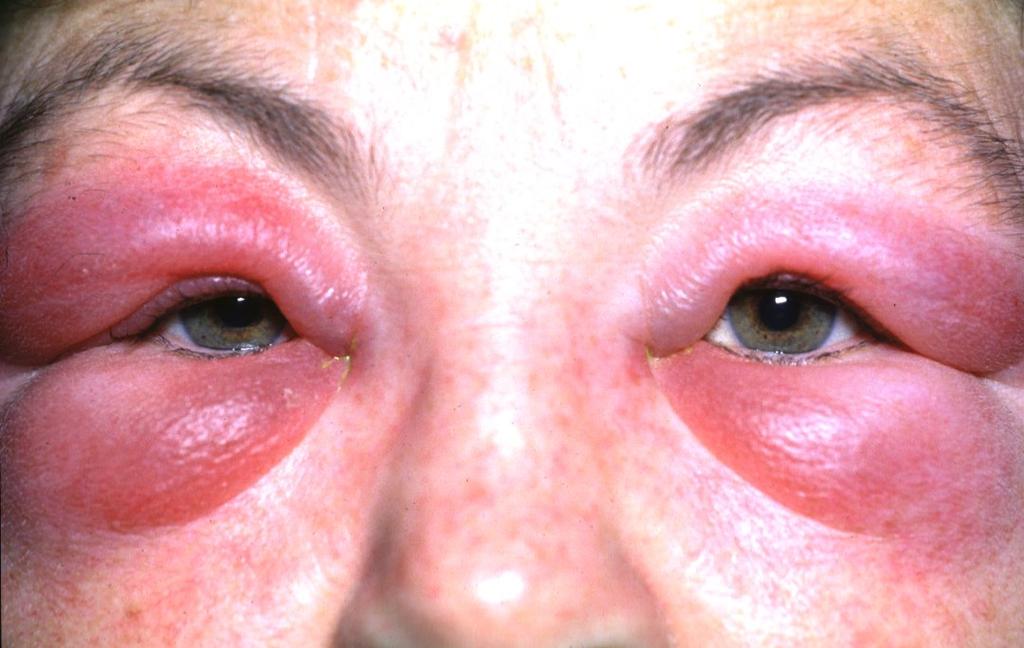 Acute allergic oedema Causes - insect bites, urticaria and angioedema Unilateral