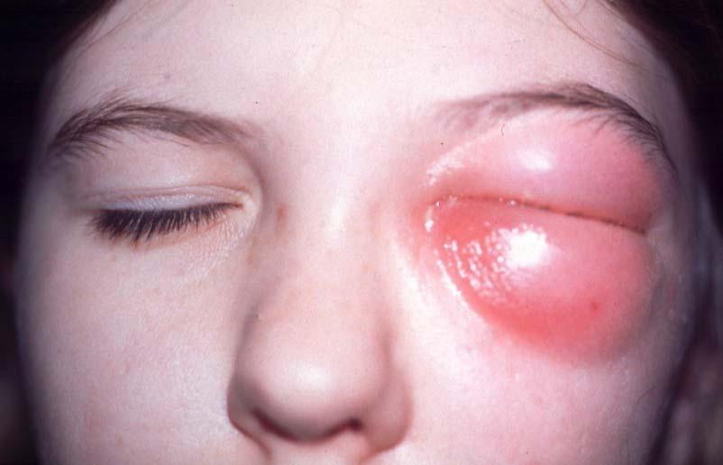 Orbital cellulitis Infection behind orbital septum Usually secondary to ethmoiditis Presentation - severe malaise, fever and