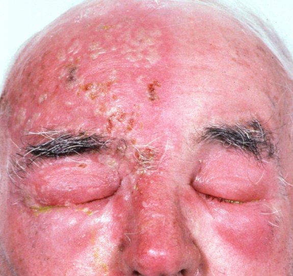 Herpes zoster ophthalmicus Painful