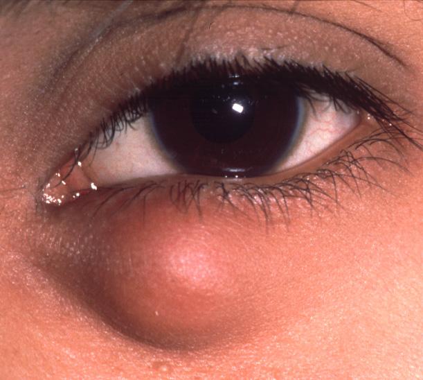 Signs of chalazion (meibomian