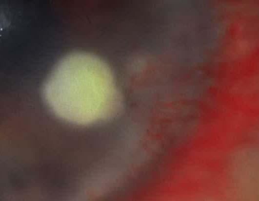 Bacterial keratitis -refer Contact lens wear Chronic ocular