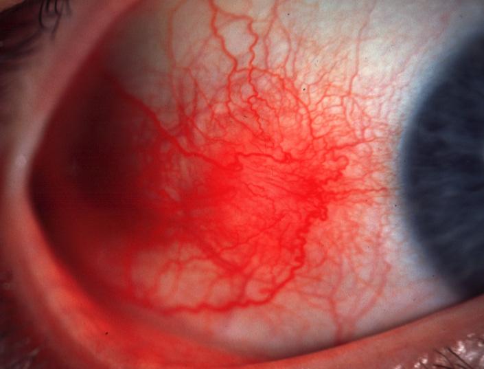 Simple episcleritis Common, benign, self-limiting but