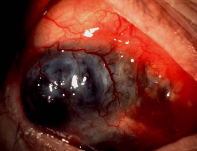 Avascular patches Scleral necrosis and visibility of uvea