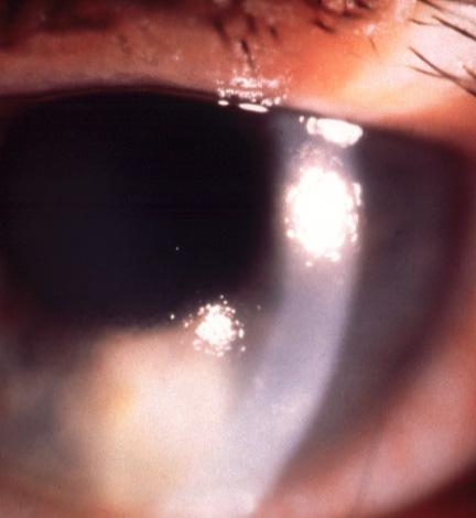 Angle-closure glaucoma