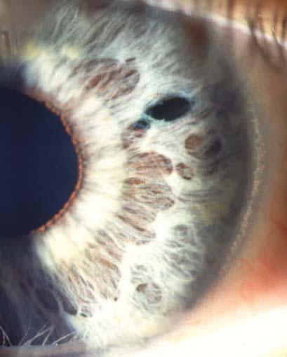 Treatment of Acute Angle-Closure Glaucoma 1. Acetazolamide i.v. 2.